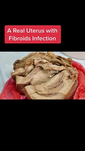 Mütter Museum received uterus with fibroid infection #fy #fyp #mutter #museum #uterus #fibroids #beautiful #viral #health #medicine #CVSPaperlessChallenge #education #women #tiktok