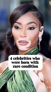4 celebrities who were born with rare condition#usa #famous #celebrity #hollywood #fyp #celebrities | Starinstant | Facebook