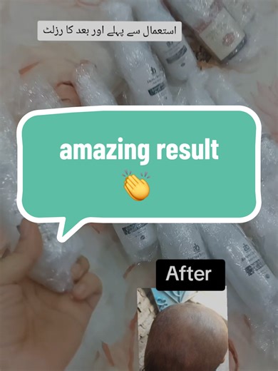 Effective Solutions for Hair Growth in Alopecia