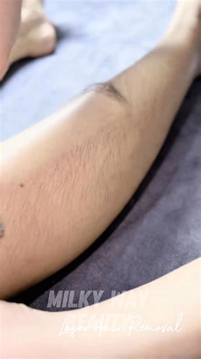 💥 FULL BODY HAIR REMOVAL - SMOOTH, NATURALLY WHITE SKIN 💥 Are you experiencing the following: ❌ Hair on arms, legs, armpits, bikini... is thick and unsightly ❌ Regularly having to shave/wax causes dark skin, folliculitis ❌ Afraid to wear short clothes, lack of confidence when communicating? 👉 It's time to remove full body hair to "transform" with velvety smooth skin! ✨ BENEFITS OF FULL BODY HAIR REMOVAL: ✅ Hair is significantly reduced after the first session ✅ Skin is brighter, pores are tig