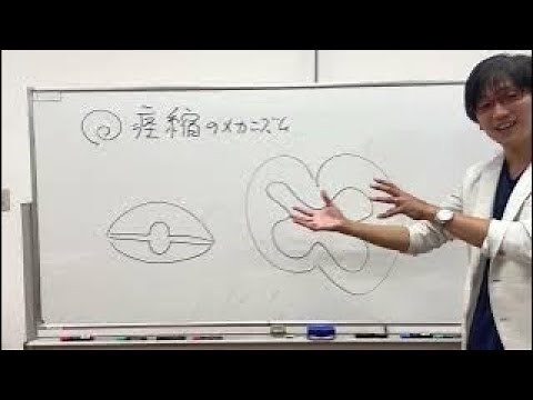 【図解】ジャックナイフ現象（折りたたみナイフ現象）：生理学
