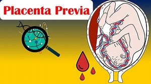 Placenta Previa - Causes, Risk Factors, Signs & Symptoms, Diagnosis, And Treatment