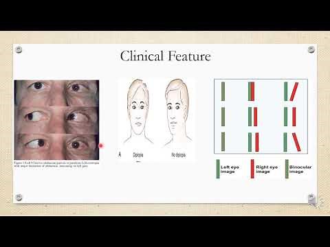 6th Nerve Palsy- Lateral Rectus palsy