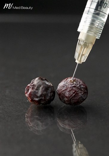 Why does hyaluronic acid work as a filler? Similar to the raisin in the video, it plumps skin from the inside out and gives it the appearance of firmer and also younger looking skin. | M1 Med Beauty