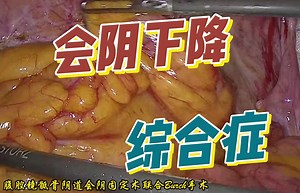 【手术】腹腔镜骶骨会阴固定术联合Burch手术_哔哩哔哩_bilibili