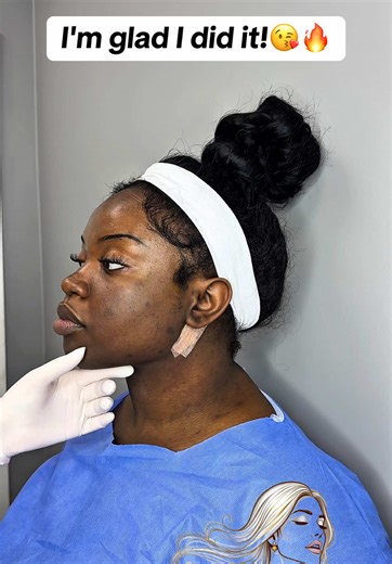 Double Chin Liposuction: Before and After Results Overview