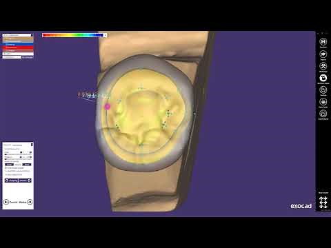 Teaser zum Lernvideo: exocad Kronenkonstruktion mit Umlauf und Interlock