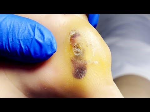 The Soles Of My Feet Are Calloused And Injured 【Pedicure Master Lin Jun】