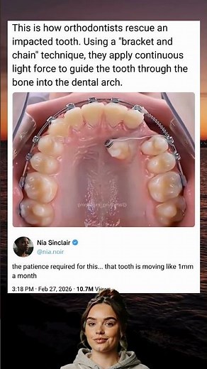 This is how orthodontists rescue an impacted tooth. Using a "bracket and chain" technique...
