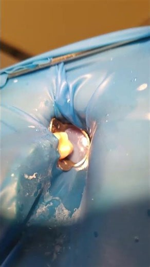 Single isolation 26 tooth.#cofferdamrubber #раббердамология