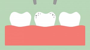 Download tooth extraction by dental tools, removal decay tooth - dental cartoon vector flat style render 2d footage animation, in 4K and UHD ultra high definition video format 3840x2160 for free