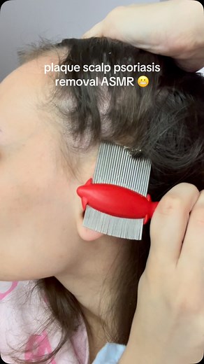 hanna 🩷 on Instagram: "lets forget that the world is crumbling and listen 2 some psoriasis asmr together 🩷🩷🩷 #psoriasis #scalppsoriasis #psoriasisawareness #psoriasiscommunity #psoriasispatches #psoriasisremoval #psoriasiswarrior"