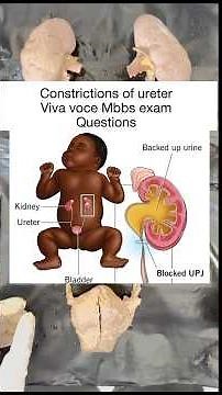 Constrictions of ureter and it’s clinical aspects