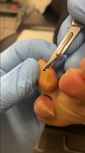 Ultimate Callus Removal: Watch a Podiatrist Transform Feet! #FootCare #CallusRemoval