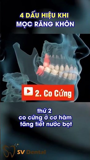 4 Dấu Hiệu Mọc Răng Khôn BẮT BUỘC PHẢI BIẾT | Khi nào cần nhổ răng khôn? | Nha Khoa SV