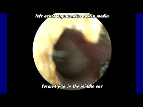 Acute Suppurative Otitis Media