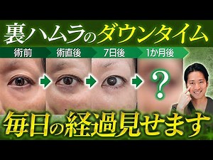 【毎日の経過大公開】裏ハムラのダウンタイム5症例徹底解説 ”失敗しないためのポイント”とは？