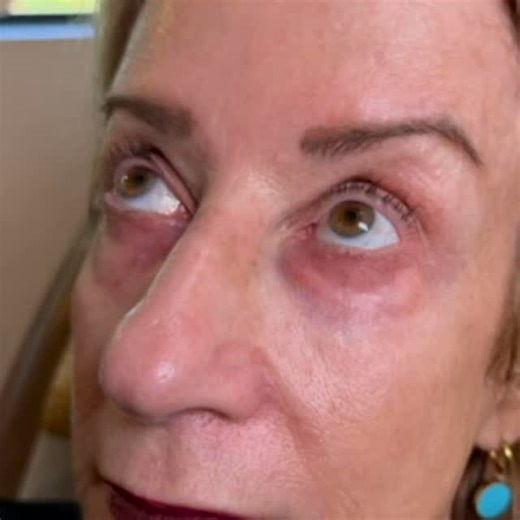 Nobody masters under-eye issues better than Tania Cohen Dermatology. We have all the tricks up our sleeves — whether it’s hollows, darkness, puffiness, or that tired, drawn look. Because the eyes aren’t just the window to the soul… they’re the window to your entire face. ✨ Expert injector. Advanced lasers. 30 years of dermatology experience. 📍 Poughkeepsie | Danbury 📞 845-485-8000 🌐 TaniaDerm.com | Tania Skin Dermatology & MediSpa