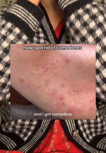 How I Got Rid of Comedones: My Skincare Journey