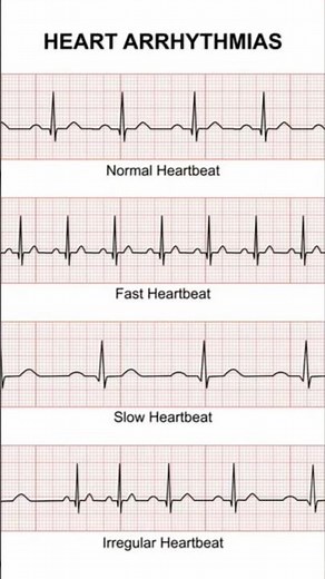 ECG - Heart Arrhythmias