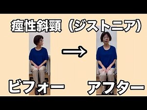 痙性斜頸（ジストニア）と診断された女性の初回施術ビフォーアフター動画
