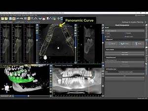 Part 2 : Mastering Advanced Mode in Blue Sky Plan - Immediate Implant Planning