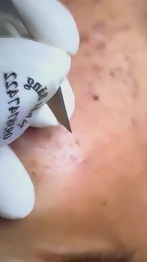 Understanding Skin Blisters: Causes and Treatments