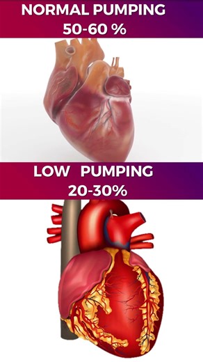 आज देखते है कमजोर हार्ट कैसे धड़कता है ? LOW PUMPING AND NORMAL PUMPING-HEART FAILURE