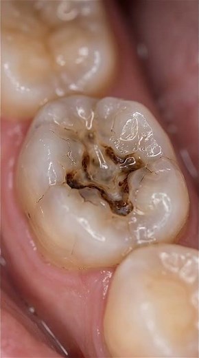 Black Grooves Vanish! 😱 Realistic Molar Restoration 🦷