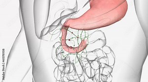 Duodenal carcinoma, also known as small intestine adenocarcinoma, is a rare form of cancer that affects the duodenum, the section of the small intestine nearest to the stomach.