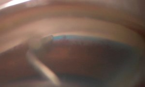 Combination Cataract Surgery and Omni Surgical System - Eyetube