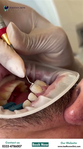 Smile Makeover Process, How We Transform Your Smile From Start to Finish: This Will Change Your Face