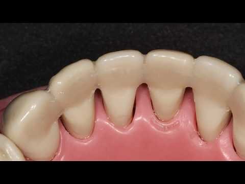 Ribbond Periodontal Splint Technique - Italian text