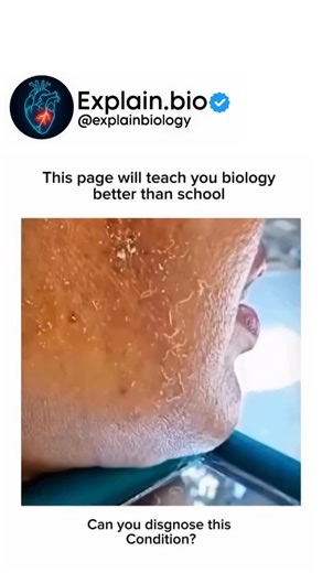 BIOLOGY | MEDICAL | HEALTH on Instagram: "cutaneous myiasis*, a parasitic infestation where fly Cutaneous myiasis is a skin infestation caused by fly larvae (maggots) that typically invade open wounds, boils, or broken skin, leading to lesions or movable lumps. It’s classified into furuncular, wound, or migratory types based on larval behavior. Treatment involves: 1. *Removing the larvae* manually or with surgical instruments. 2. *Cleaning the wound* through irrigation. 3. *Debridement* of damag
