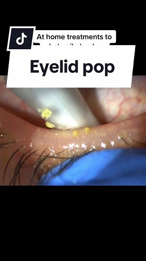 Understanding and Treating Dry Eyes: Home Remedies and In-Office Treatments