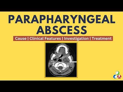 Parapharyngeal Abscess