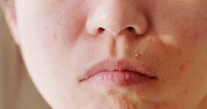 clip-1099575765-close-asian-woman-has-acne-problem-on