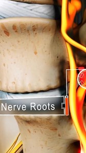 Bone spurs narrowing your spinal canal? That's lumbar spinal stenosis—and it causes radiating leg pain. 👇 | Spine-health