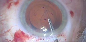 Descemet Stripping Only - Eyetube