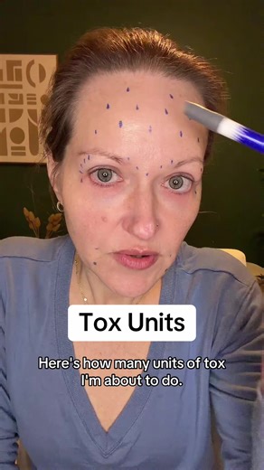 Botulax Injection Units per Site Explained