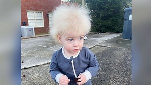 One-year-old boy has extremely rare ‘uncombable hair syndrome’
