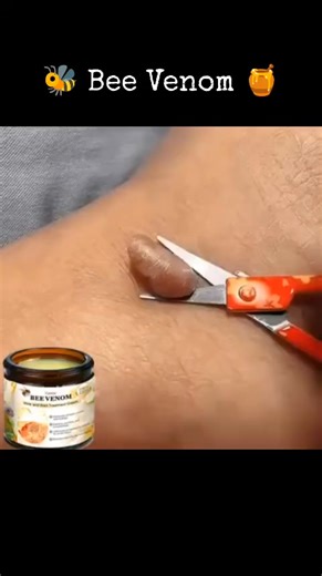 🌿 Say Goodbye to Skin Problems – The Natural Way with BEEVENOM TREATMENT CREAM Tired of dealing with skin tags, moles, Stretch marks dark spots, rashes, or eczema? You deserve smooth, glowing skin — without harsh chemicals or surgery! ✨ Introducing Miracle Bee Venom Cream ✨ Powered by pure bee venom and healing herbal extracts, this powerful cream penetrates deep into your skin to repair, restore, and rejuvenate, revealing a flawless, radiant glow. 💛 Perfect For: ✔ Skin Tags, Stretch marks & M