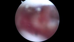 Elbow Arthroscopy