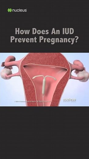 How Does An IUD Prevent Pregnancy? #shorts