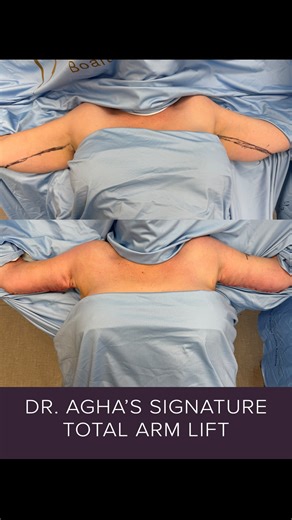Siamak Agha, MD PhD FACS on Instagram: "Today we performed my signature total arm lift. The total arm lift is my revolutionized technique that has refined the L-brachioplasty technique over twenty years. This procedure addresses excess arm skin, tightens the elbow area, and elevates the armpit for a balanced contour. This is the second stage of our patient’s transformation. She previously had an extended tummy tuck and breast work done elsewhere, and then we completed a bra line upper body lift 