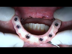 Zest LOCATOR F-Tx with Flapless Guided Navigator Surgery and an Immediate Bridge - Dr. Del Castillo