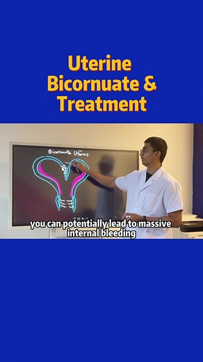 Understanding Bicornuate Uterus - Pregnancy Risks & Management