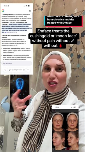 Treating Moon Face Caused by Steroids with Emface