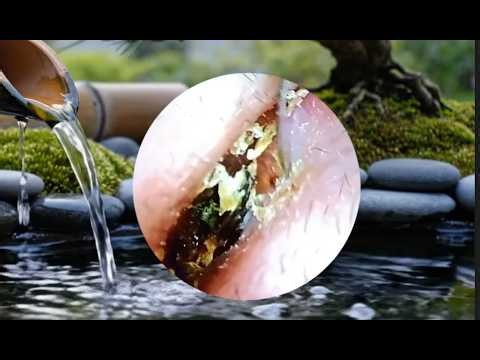 耳掃除/耳垢の除去 耳垢そうじ 難聴を伴う巨大な右耳垢 | Earhelth