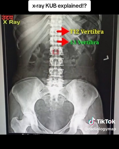 Understanding X-Ray KUB: Kidney and Urinary Tract Insights
